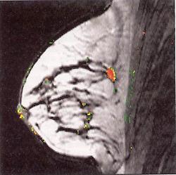 Dynamische MR-Mammographie zur Charakterisierung des Tumormikrogefäßsystems.