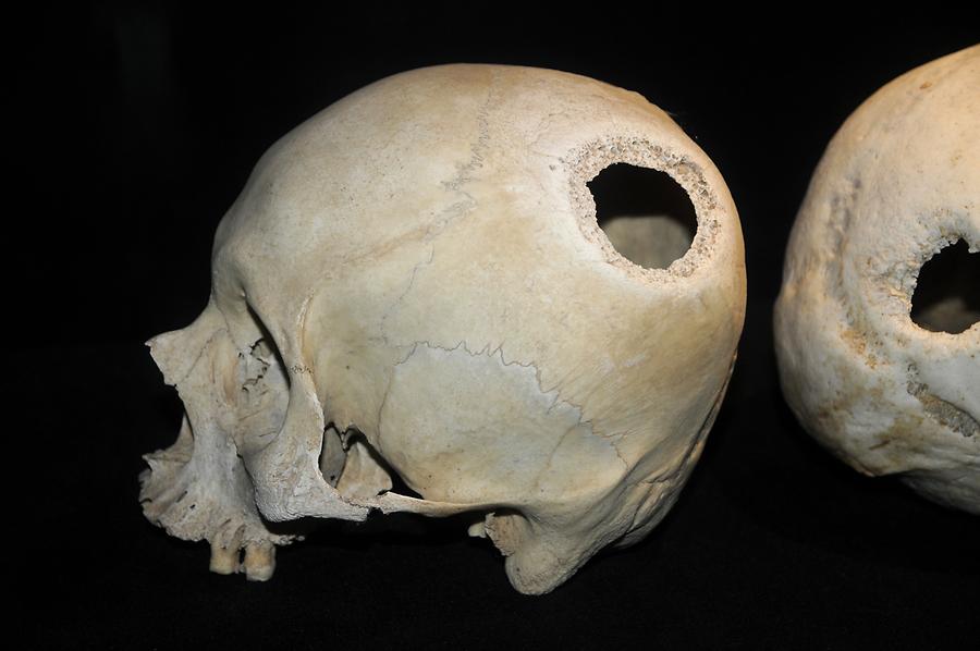 Trepanations (Museum in Ica, Peru)