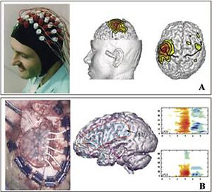 Abb. 1: Beispiele für Vielkanal-EEG (A) und ECoG Ableitungen (B)