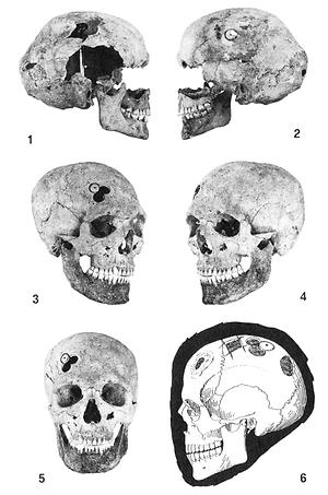 Abb. 54: Früh- bis mittellatenezeitliche Trepanationen