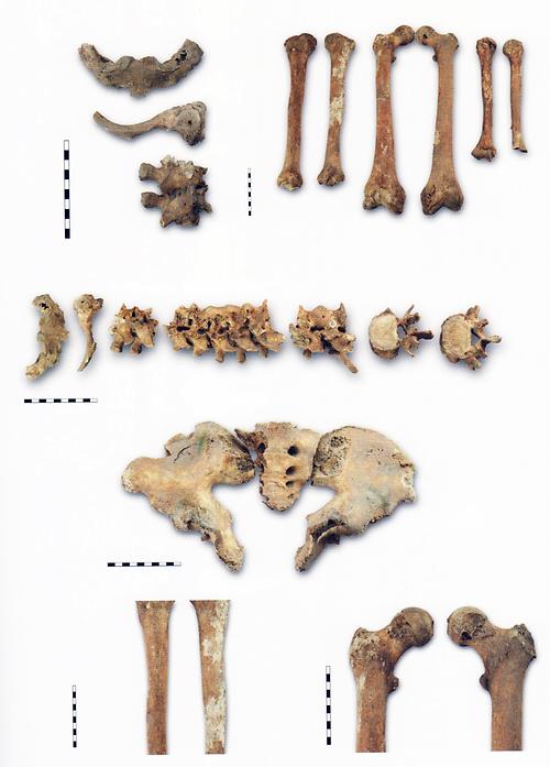 Details der Skelettteile aus Grab 88 mit Spuren des Krankheitsbildes „Morbus Bechterew'.