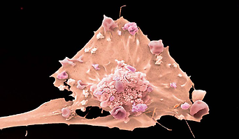 Brustkrebs-Zelle in Vergrößerung: Die Heilungschancen bei Mammakarzinom sind gestiegen., Foto: corbis