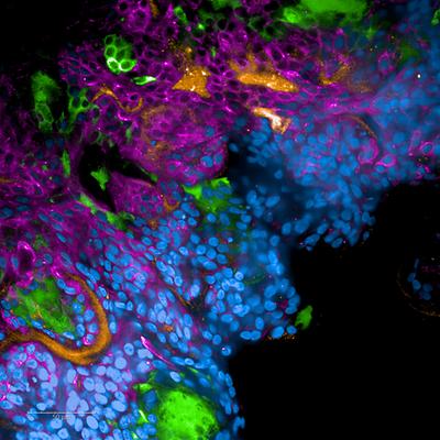 Fluoreszenzmikroskopische Aufnahme eines mit SARS-CoV-2-infizierten Lungengewebes