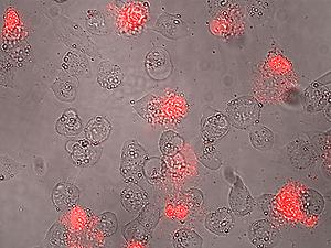 Mit dem Antitumor-Peptid behandelte Hautkrebszellen: Auf Bläschenbildung folgen starke Membranschädigungen und Zelltod (rot)