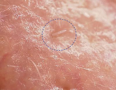 Abb. 1: Mikroskopische Aufnahme einer in einer Hautpore steckenden Demodex folliculorum-Milbe
