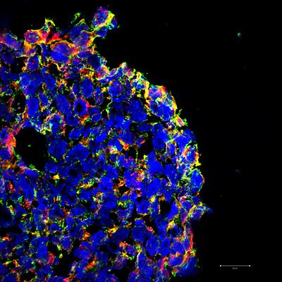 dreidimensionales Darmkrebs-Zellkulturmodell