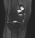 MRT-Bild (koronare PDfs-Sequenz) eines histologisch gesicherten Riesenzelltumors des Oberschenkelknochens
