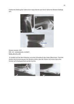 Image of the Page - 22 - in Das Lazarett in der Frauenstrafanstalt - Bericht von med. Heinrich Wallnöfer über die Arbeit mit der Siemens’schen Metallsuchersonde